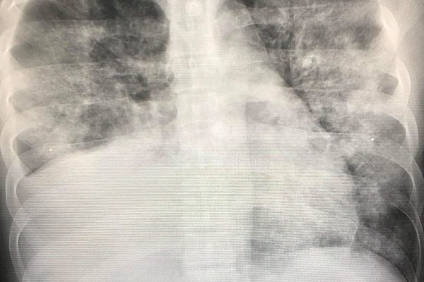 Vaping Disease (EVALI/VAPI) Hits First Thai Patient