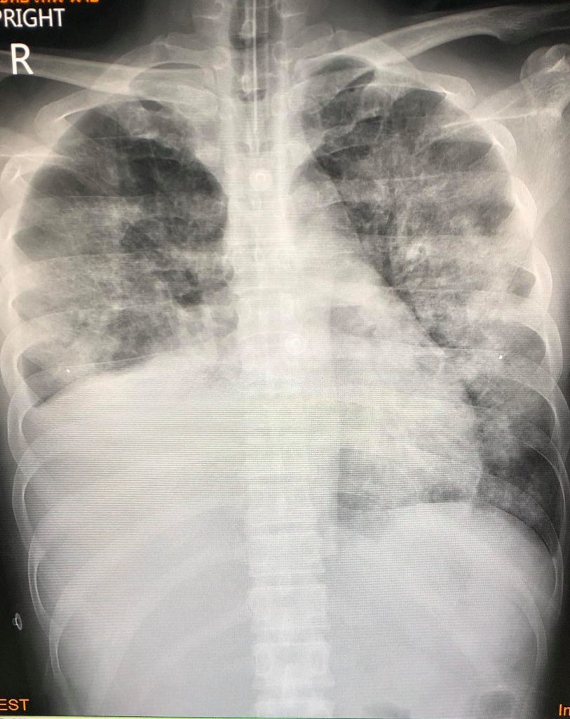 Vaping Disease (EVALI/VAPI) Hits First Thai Patient – thailandTHC